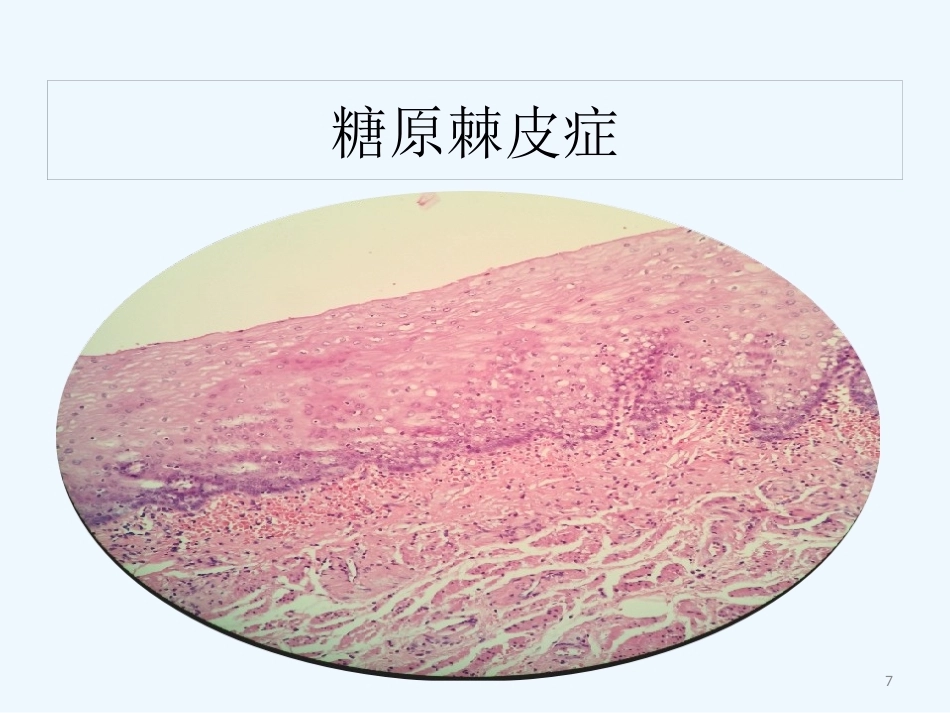 早期食管黏膜病变病理学形态_第7页