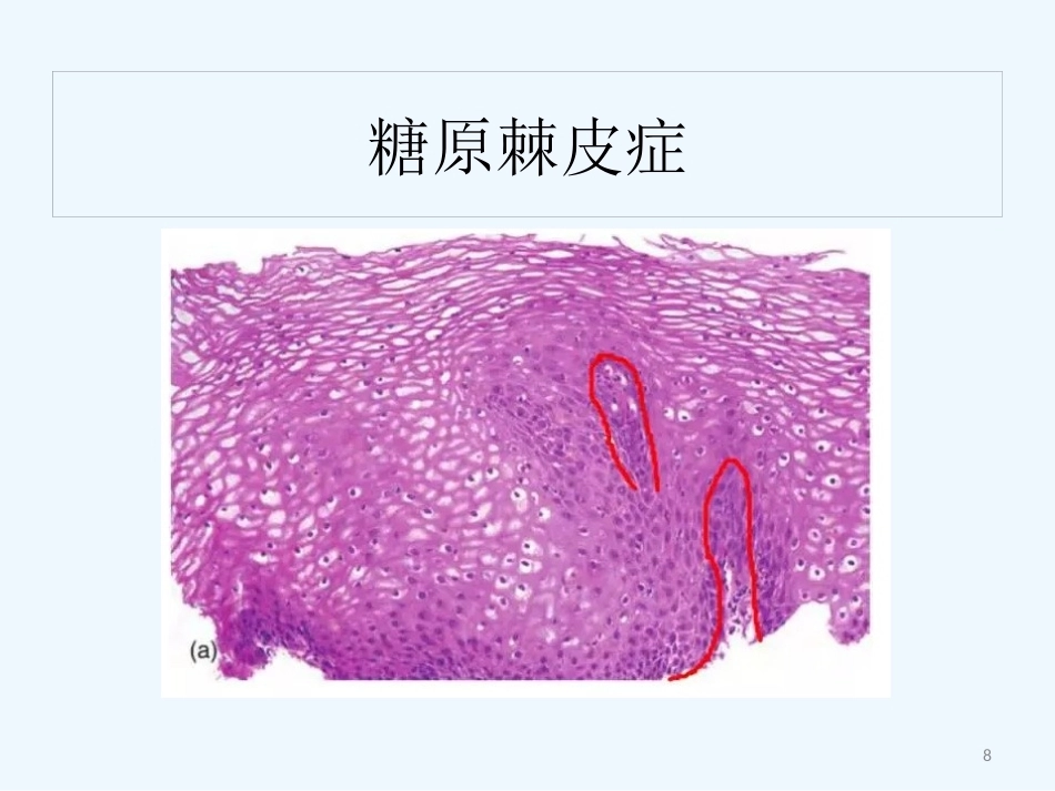 早期食管黏膜病变病理学形态_第8页