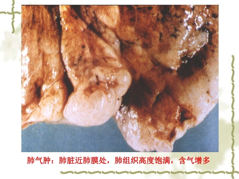 呼吸系统疾病-病理学_第12页