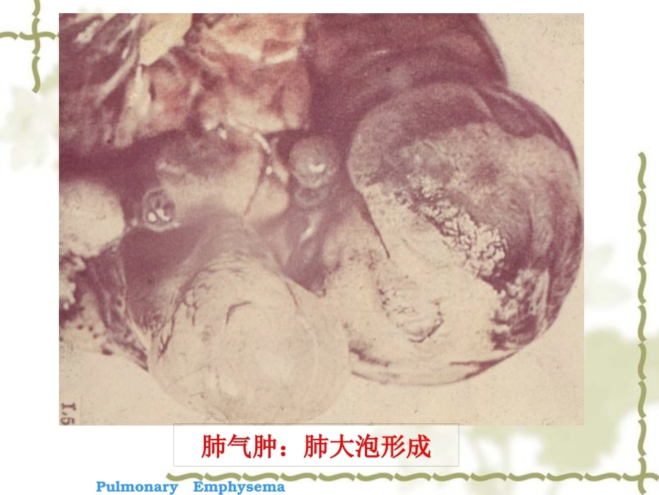 呼吸系统疾病-病理学_第13页