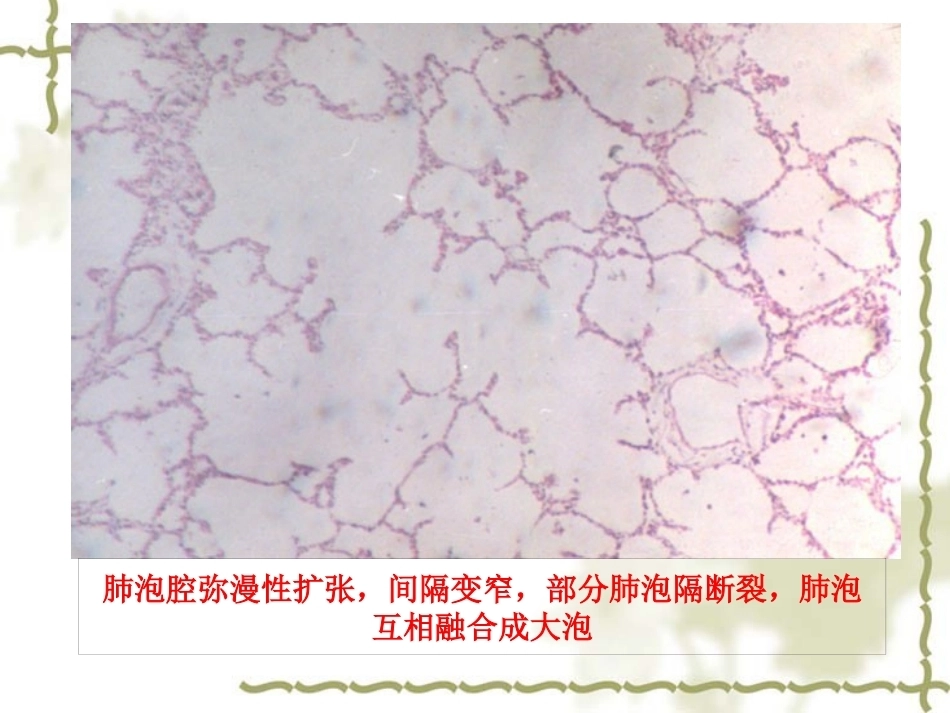 呼吸系统疾病-病理学_第14页