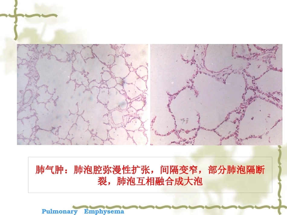 呼吸系统疾病-病理学_第15页