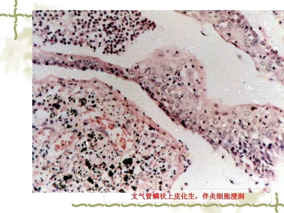 呼吸系统疾病-病理学_第8页