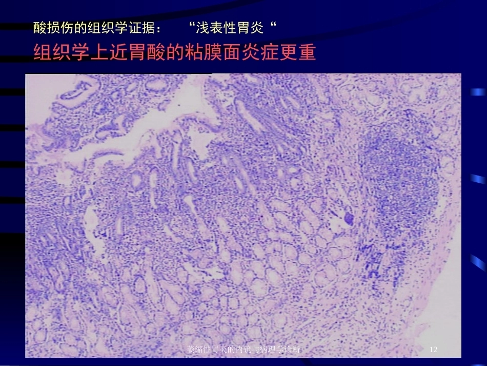 萎缩性胃炎的内镜与病理学诊断_第12页