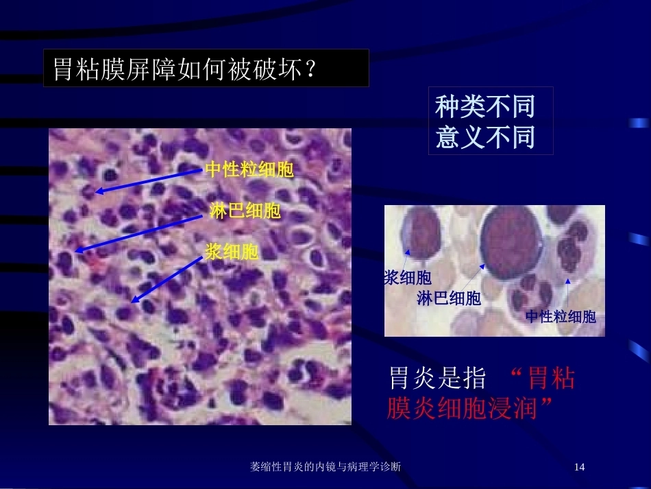 萎缩性胃炎的内镜与病理学诊断_第14页