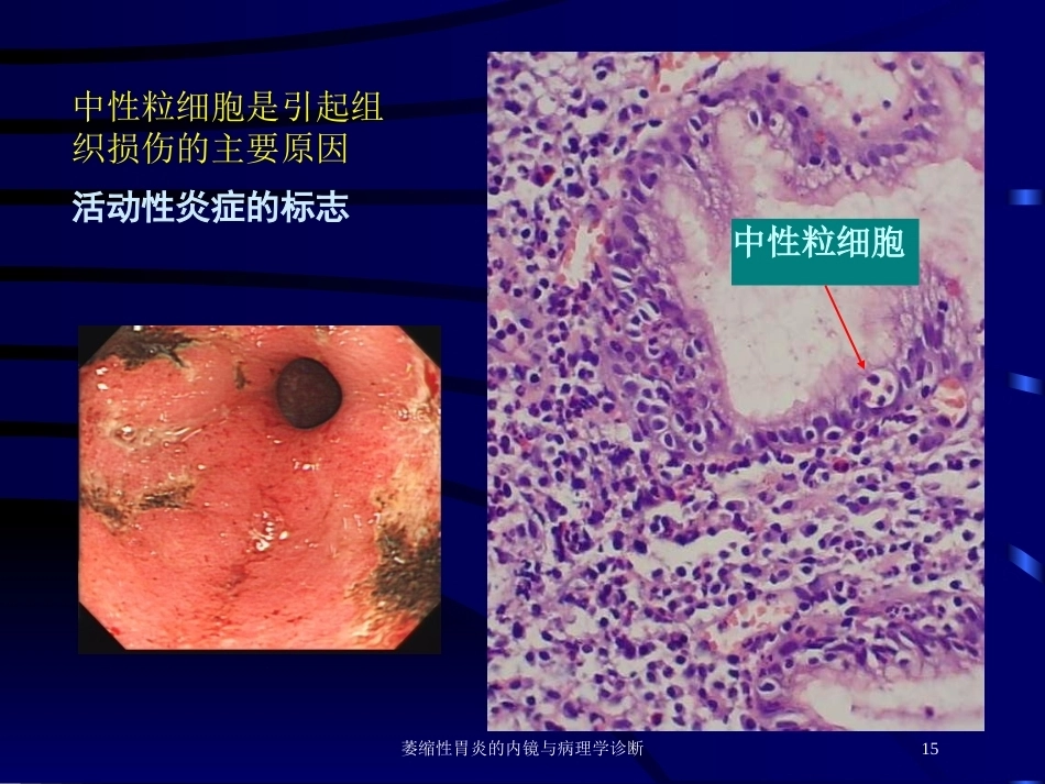 萎缩性胃炎的内镜与病理学诊断_第15页