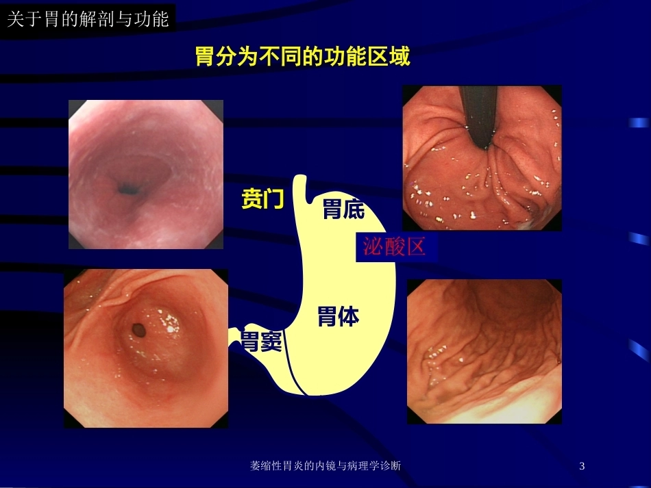 萎缩性胃炎的内镜与病理学诊断_第3页
