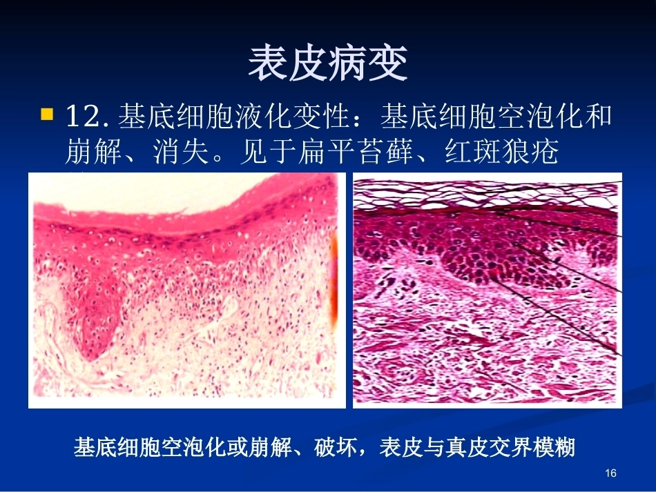 皮肤组织病理学PPT课件_第15页