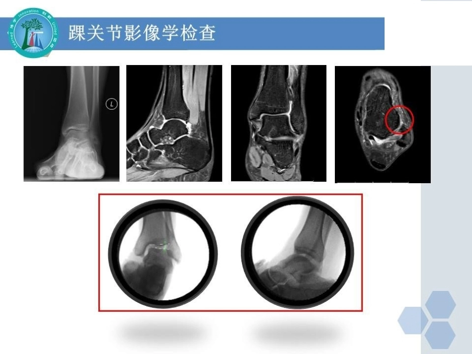 关节镜下Internal brace人工韧带加强修复术治疗距腓前韧带损伤_第8页
