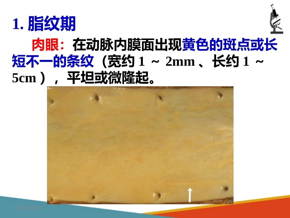 心血管系统疾病—动脉粥样硬化(病理学课件)_第3页