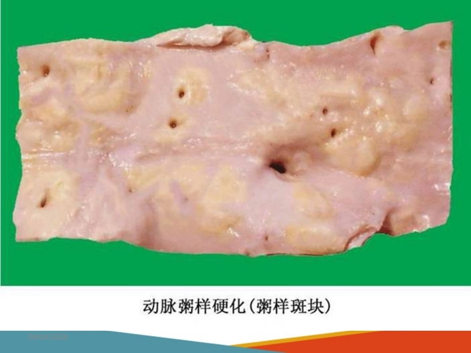 心血管系统疾病—动脉粥样硬化(病理学课件)_第7页