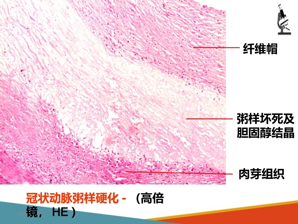 心血管系统疾病—动脉粥样硬化(病理学课件)_第8页