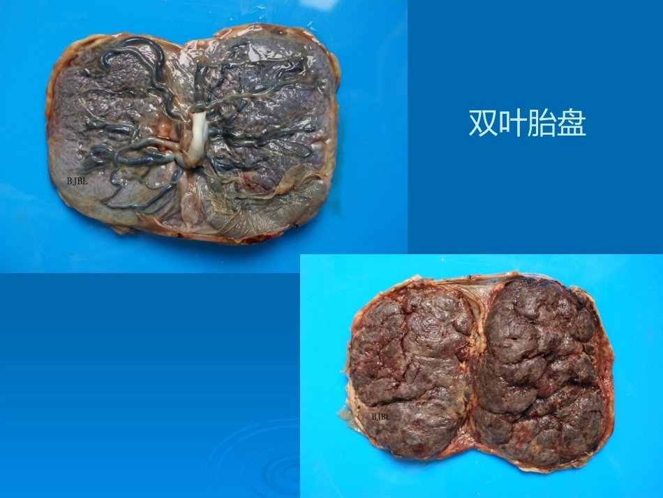 胎盘病理学胎盘病理基本类型_第11页