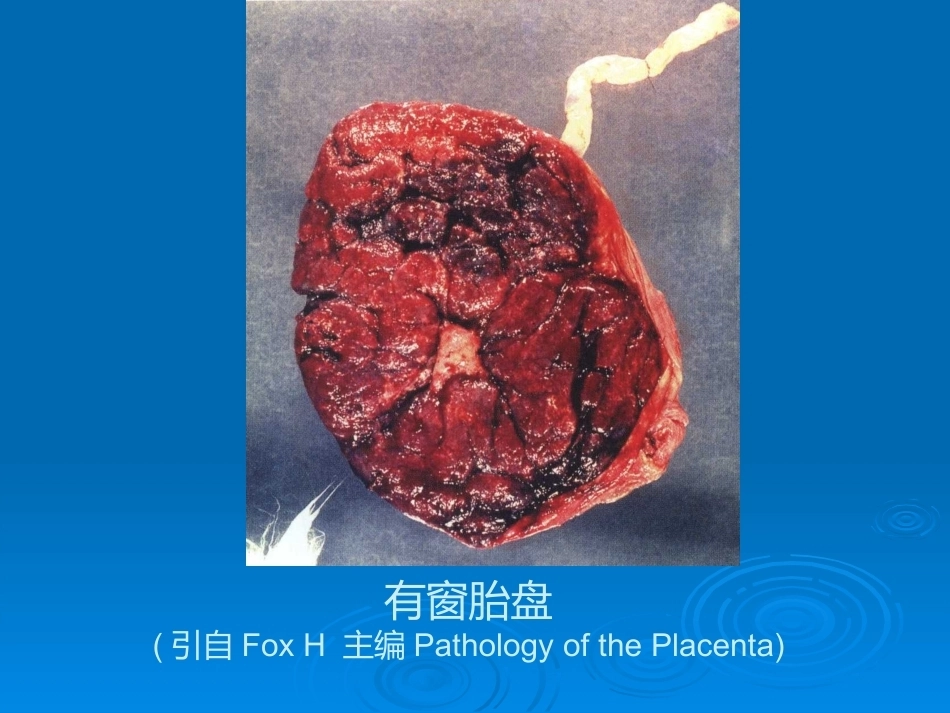 胎盘病理学胎盘病理基本类型_第13页
