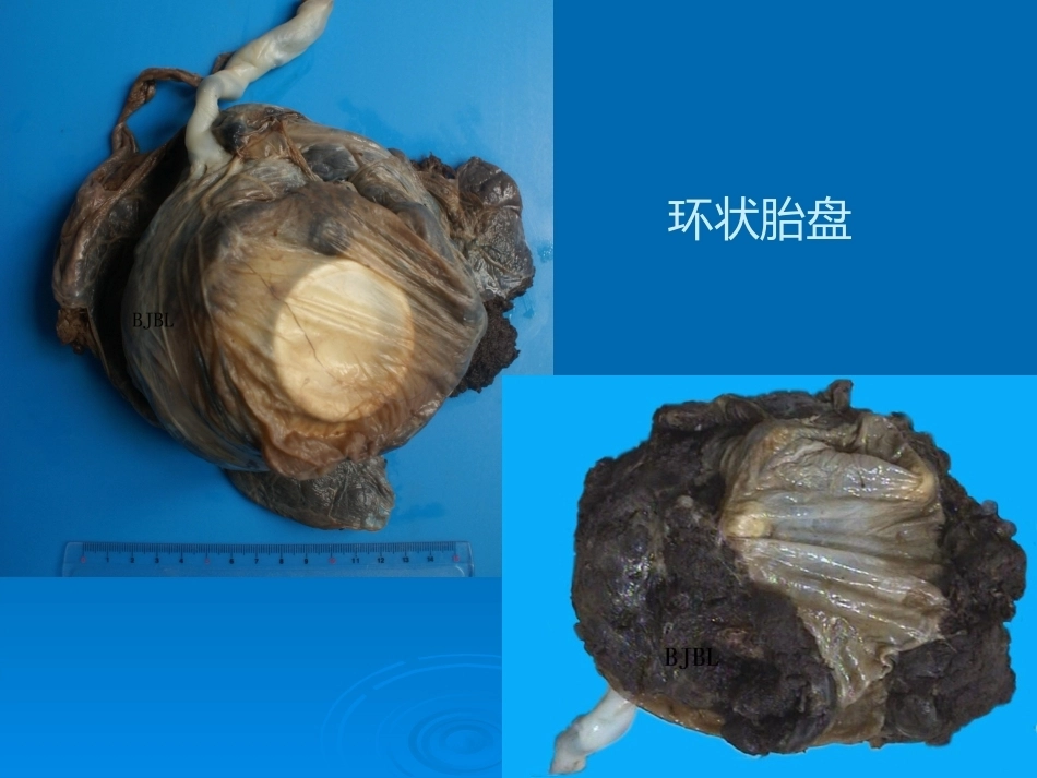 胎盘病理学胎盘病理基本类型_第15页