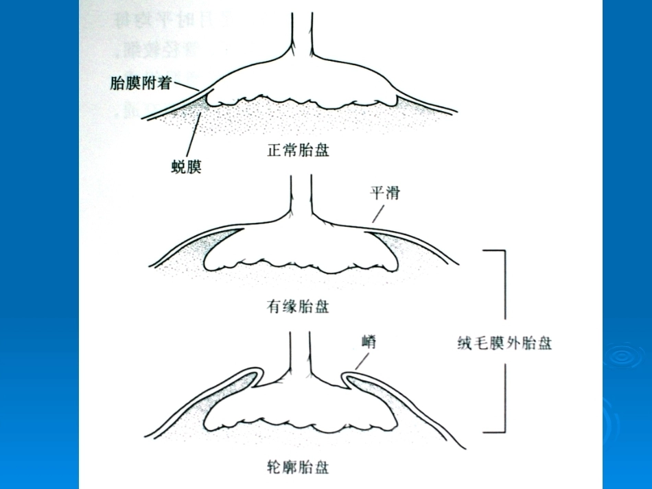胎盘病理学胎盘病理基本类型_第5页