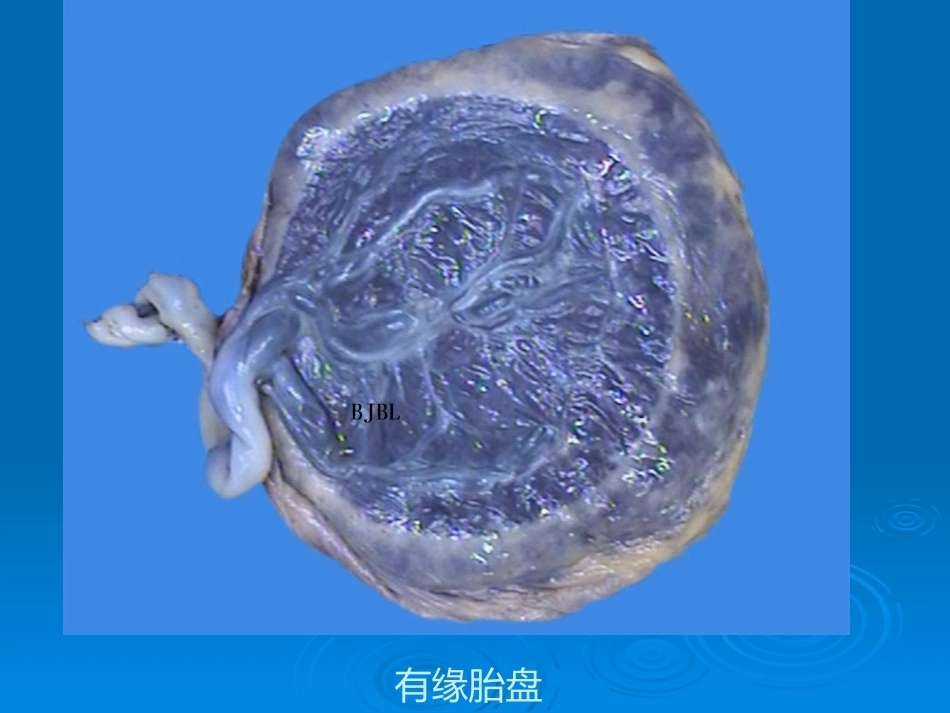 胎盘病理学胎盘病理基本类型_第6页