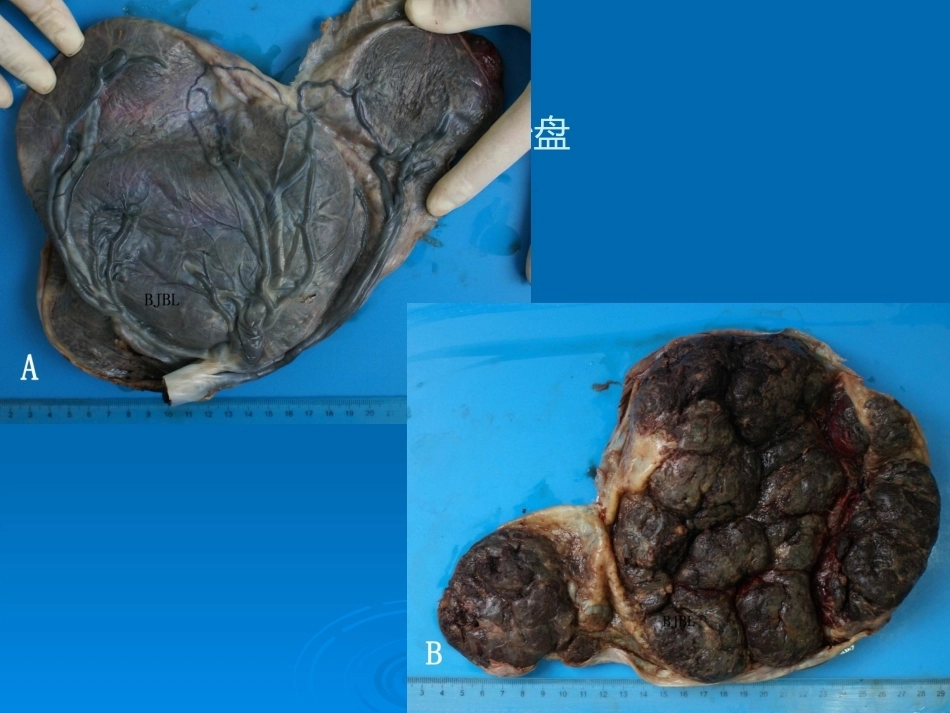 胎盘病理学胎盘病理基本类型_第9页