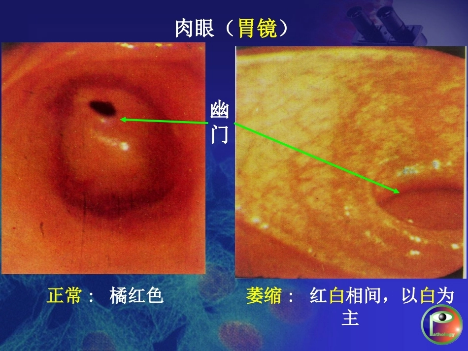 胃炎 病理学_第12页