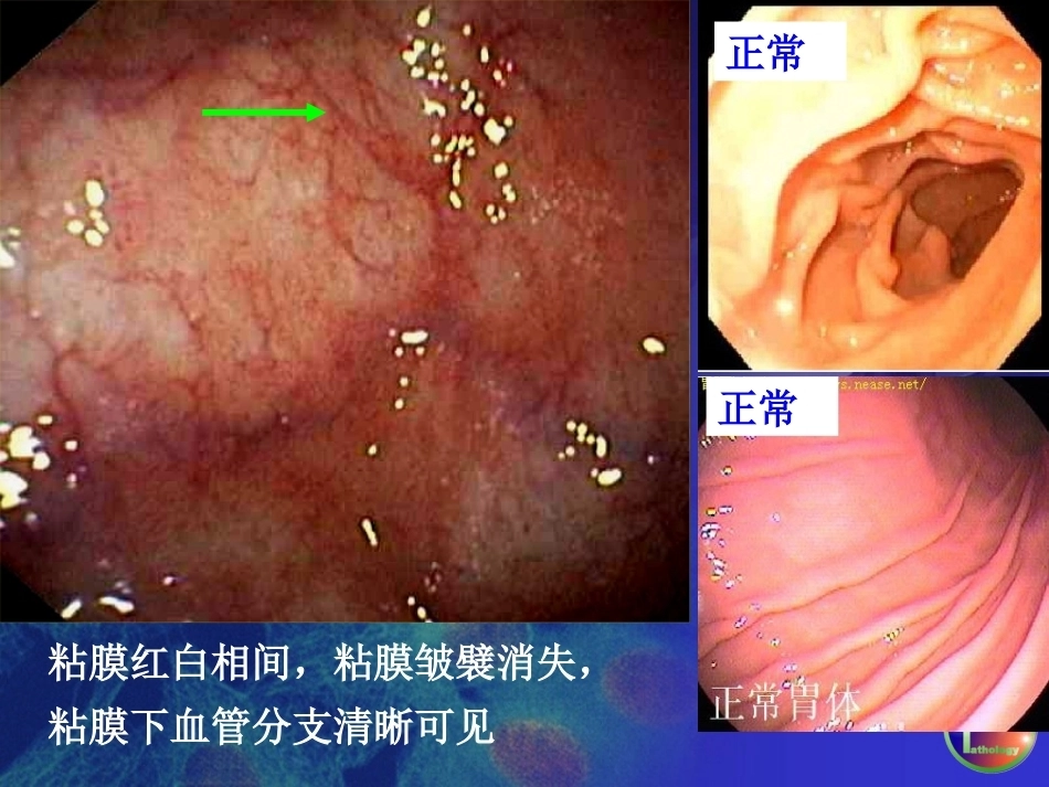 胃炎 病理学_第13页