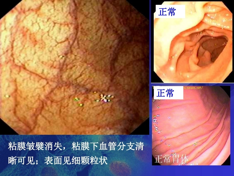 胃炎 病理学_第14页