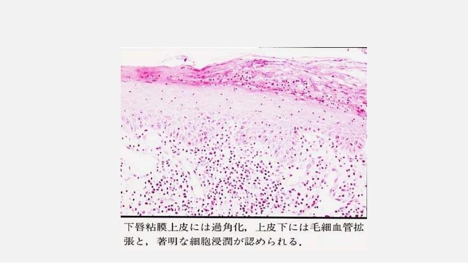 口腔组织病理学口腔粘膜病病理_第10页
