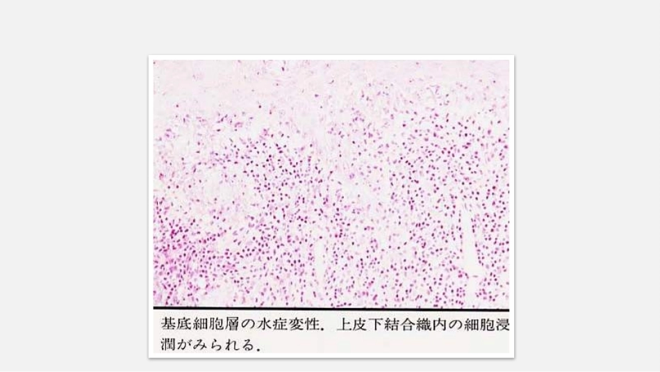 口腔组织病理学口腔粘膜病病理_第11页