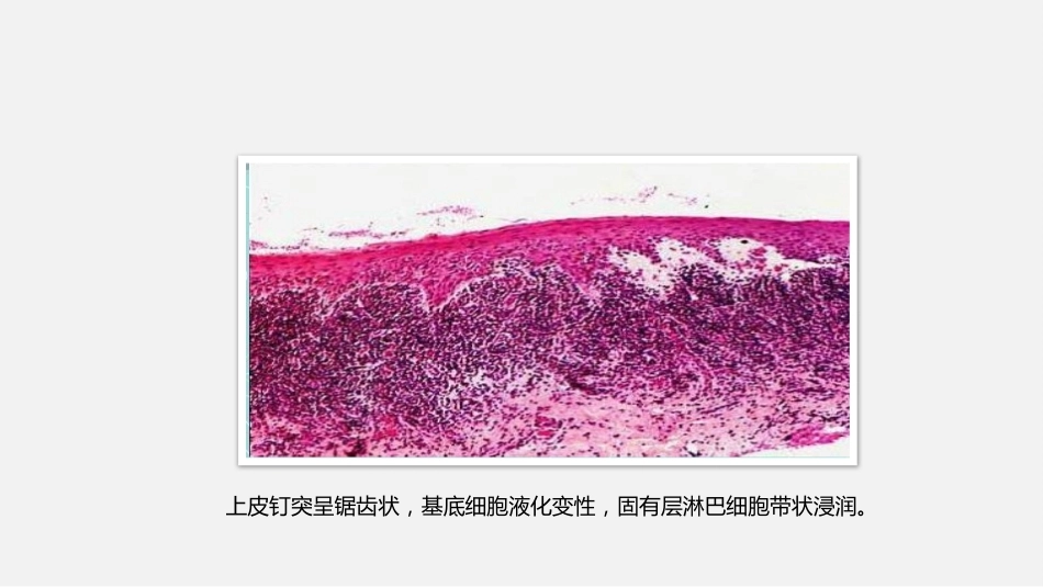 口腔组织病理学口腔粘膜病病理_第6页