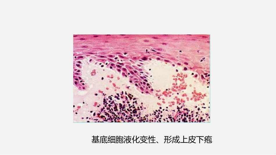 口腔组织病理学口腔粘膜病病理_第7页