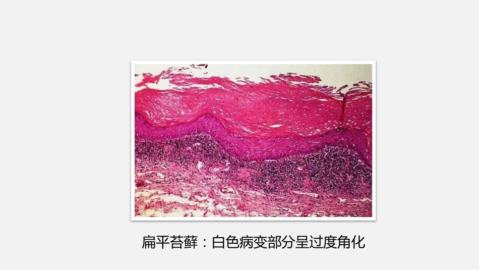 口腔组织病理学口腔粘膜病病理_第8页