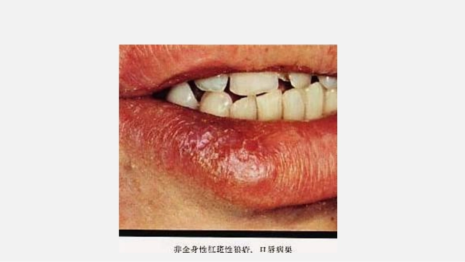 口腔组织病理学口腔粘膜病病理_第9页