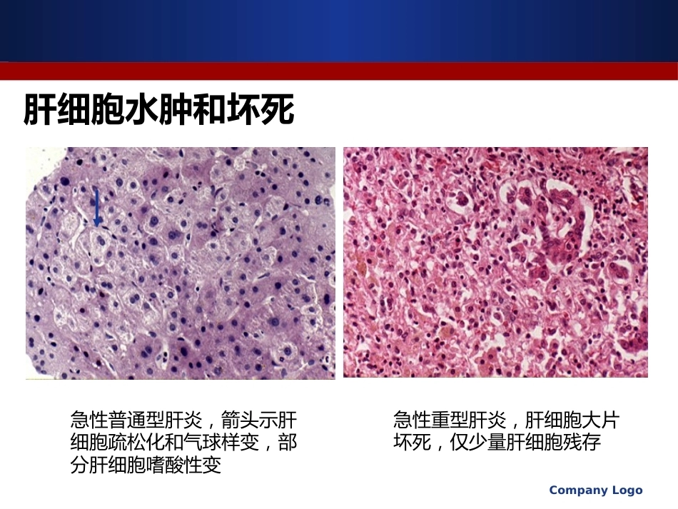 医学病理学 炎症_第13页