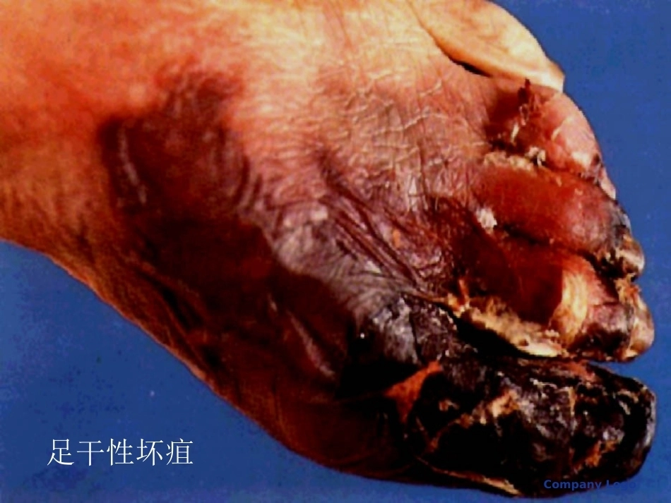 医学病理学 炎症_第14页