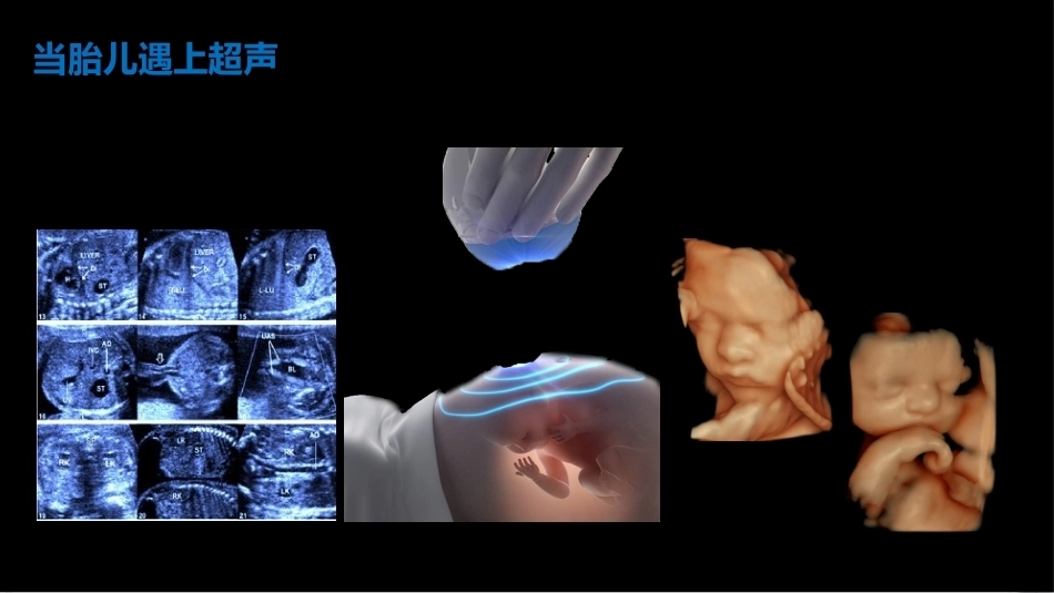 产前超声医学科普演讲_第4页