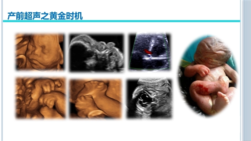 产前超声医学科普演讲_第6页