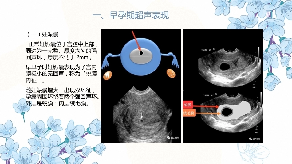 产科超声PPT正常妊娠超声表现异常妊娠 超声表现_第12页