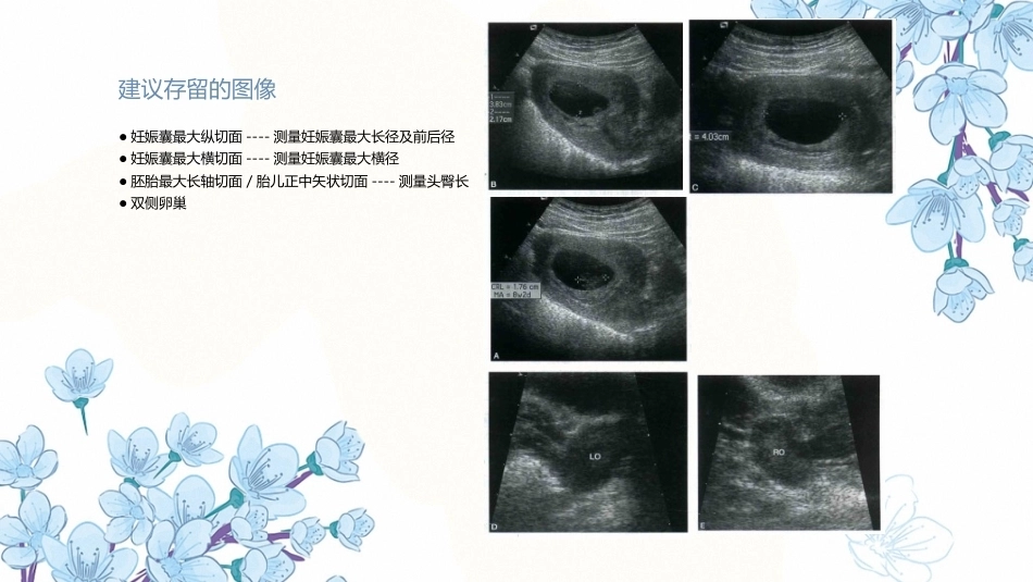 产科超声PPT正常妊娠超声表现异常妊娠 超声表现_第7页
