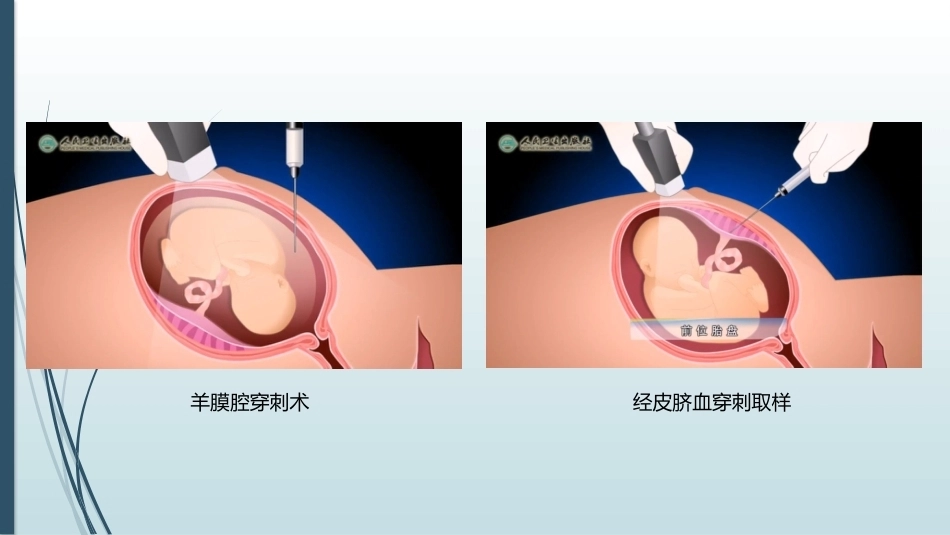 产前筛查和产前诊断常用的检查方法_第14页