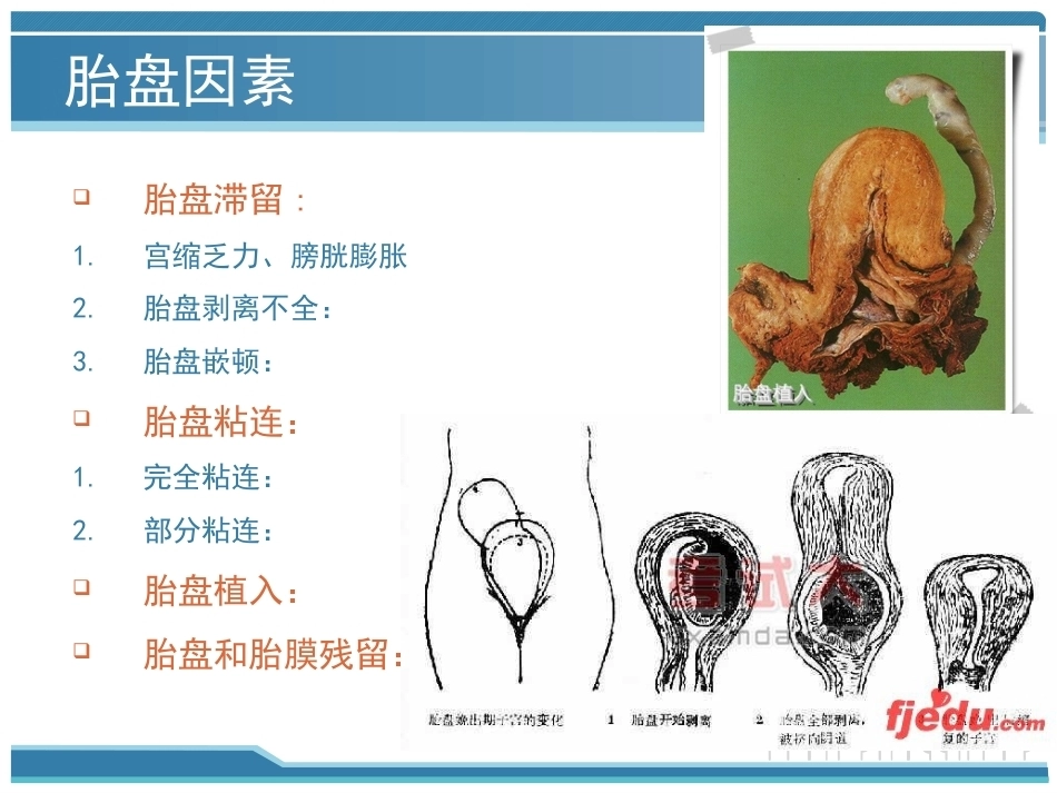 妇产科护理课件-分娩期并发症_第12页