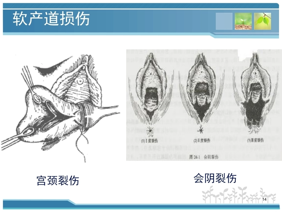 妇产科护理课件-分娩期并发症_第14页