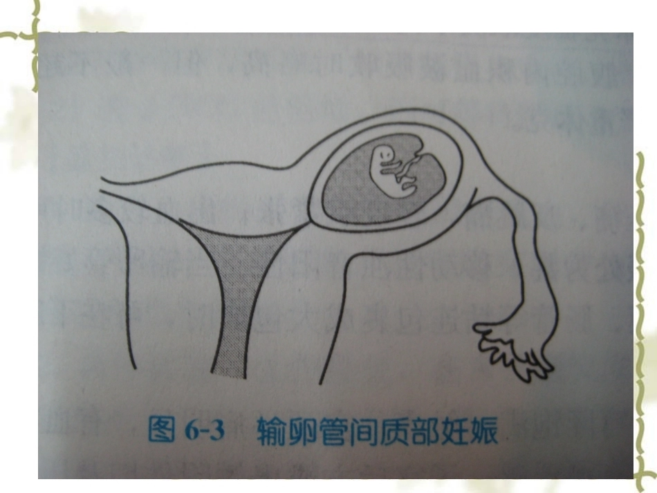 教学查房——异位妊娠(宫外孕)_第10页