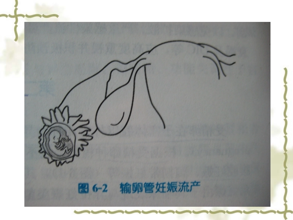 教学查房——异位妊娠(宫外孕)_第14页