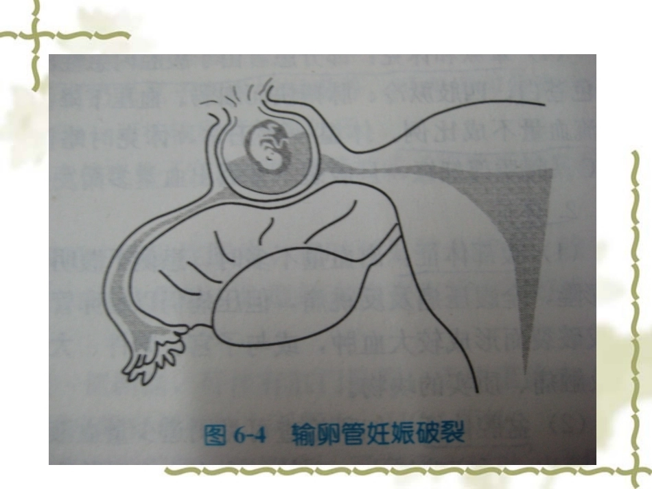 教学查房——异位妊娠(宫外孕)_第15页