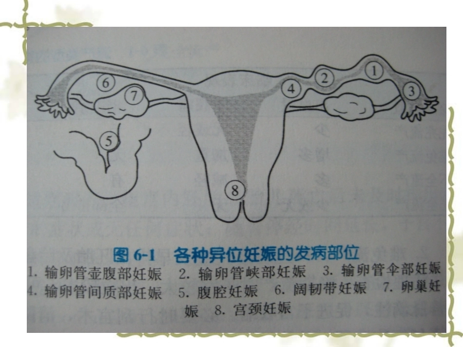 教学查房——异位妊娠(宫外孕)_第9页