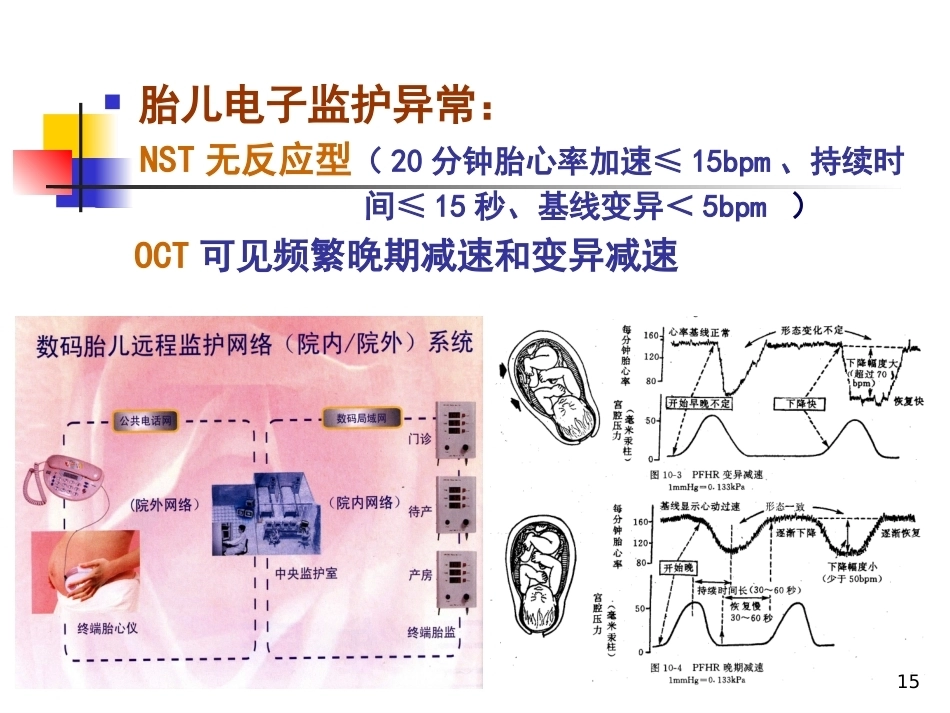 妇产科护理胎儿窘迫_第15页