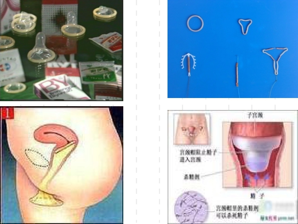 妇产科护理学-课程课件-计划生育妇女护理_第9页