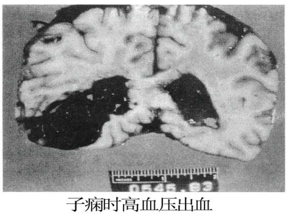 妇产科护理学-妊娠期高血压疾病_第15页