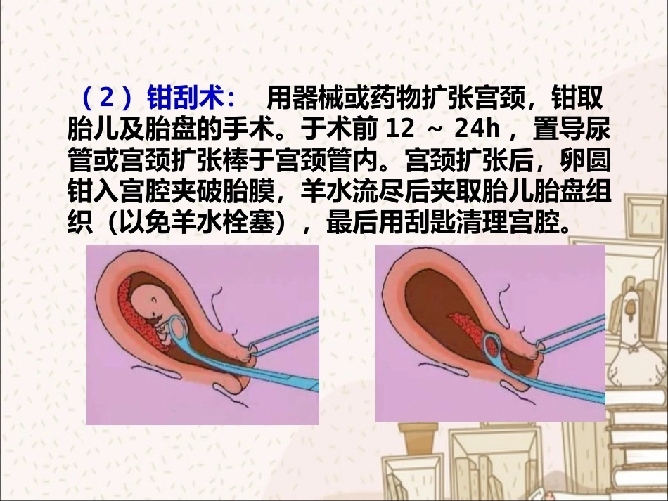 人工终止妊娠术前术后护理_第6页