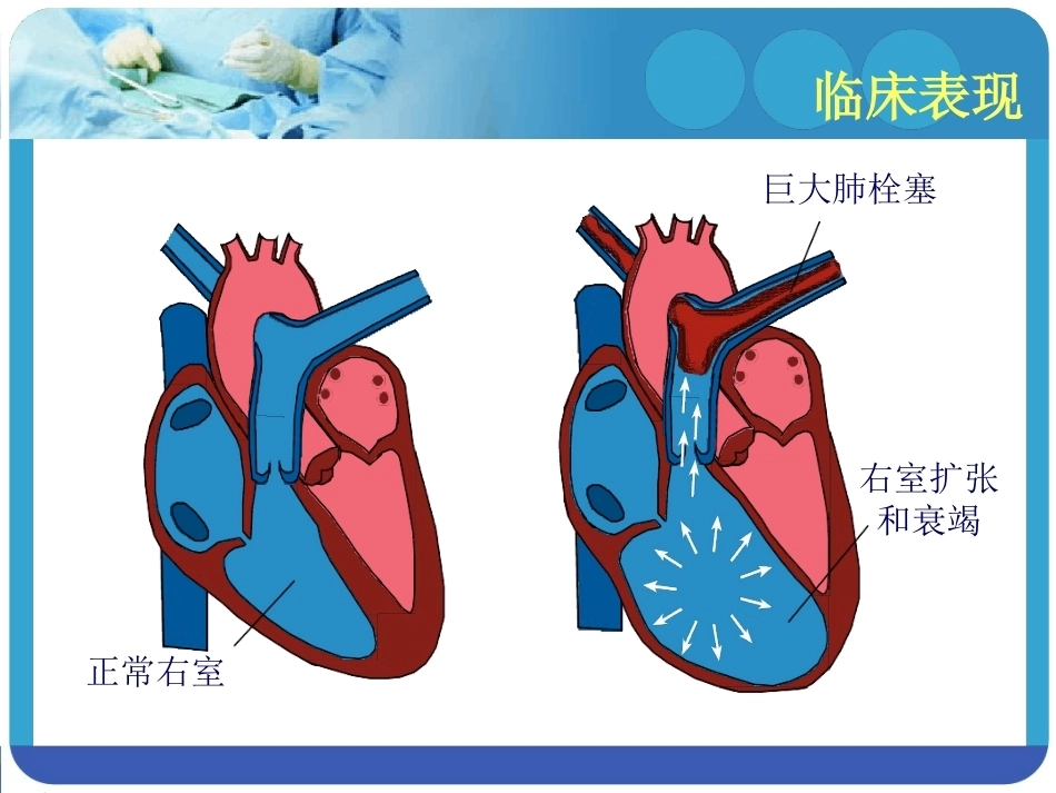 肺栓塞的预防及处理_第12页