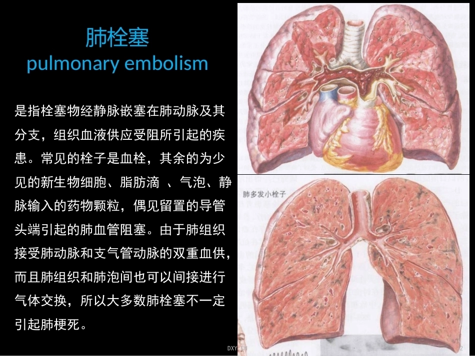 关于肺栓塞_第2页